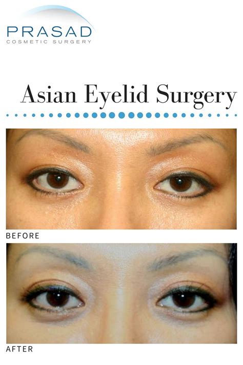 A woman named ng from kuala lumpur underwent a dst (double suture and twist) surgery as well as an eyelid fat removal surgery, and wound up with a hugely. Asian Eyelid Surgery - Double eyelid surgery