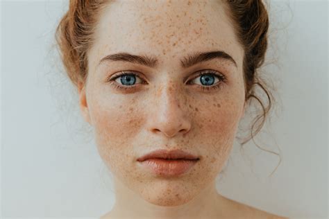 Freckles On Skin An Expert On Whats Normal And Whats Not Dose