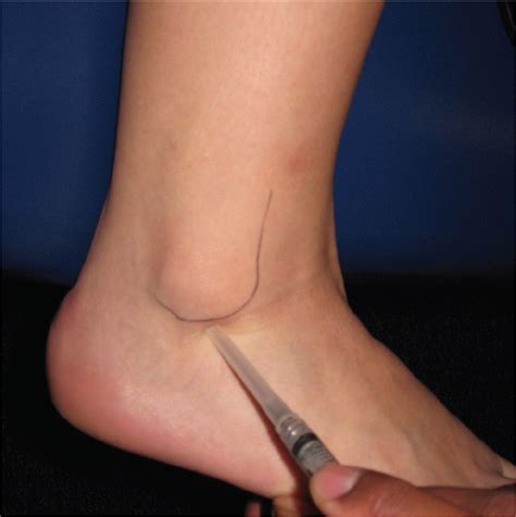 Anyone know what this could be? Heel Pain: Diagnosis and Management - American Family ...