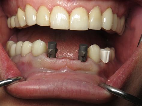 Immediate Implant Bridge Lower Jaw Front Teeth Ramsey Amin Dds