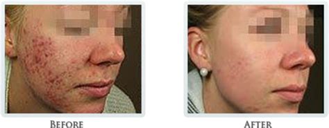 Micro Needling Acne Scars Before And After Before And After