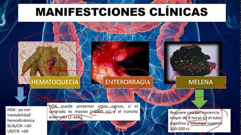Hemorragia digestiva baja HDB Etiología Diagnóstico y Tratamiento