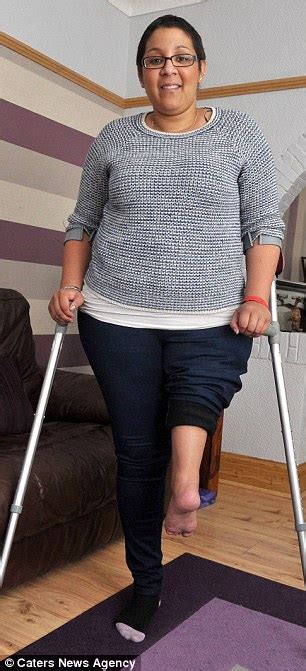 Amazing Stories Around The World Woman Who Lost Part Of Her Leg To