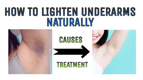 How To Lighten Underarms Naturally Causes Treatment Youtube