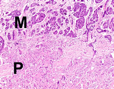 Pathology Outlines Diffuse Malignant Mesothelioma