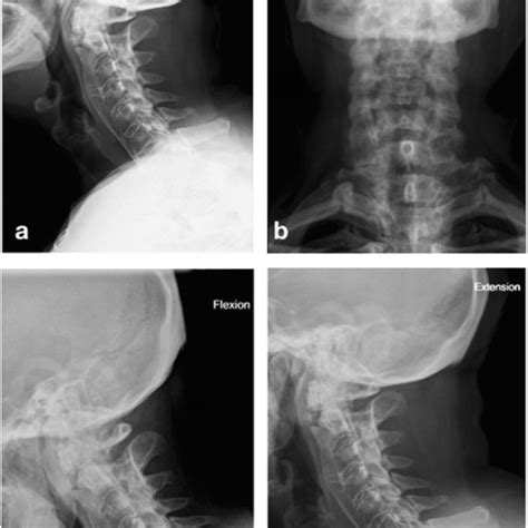 Postoperative Dynamic X Ray Control A Lateral Cervical Spine B