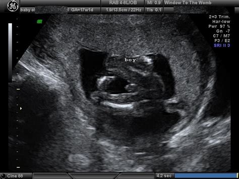 Its A Boy 16 Weeks Pregnant Ultrasound Baby Scan 6 Weeks Pregnant