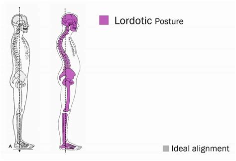 When Lumbar Lordosis Becomes A Problem Spinal Backrack