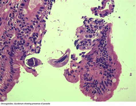 Pathology Outlines Hivaids Associated