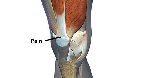 Quadriceps Tendonitis Causes Treatment Knee Pain Explained The Best Porn Website