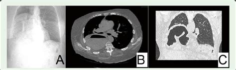 A Ct Topogram Shows Herniation Of The Liver And Large Bowel Loops