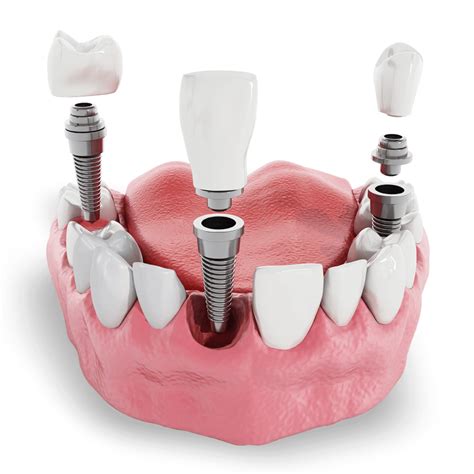 Single Dental Implant Beverly Hills Northridge Thousand Oaks