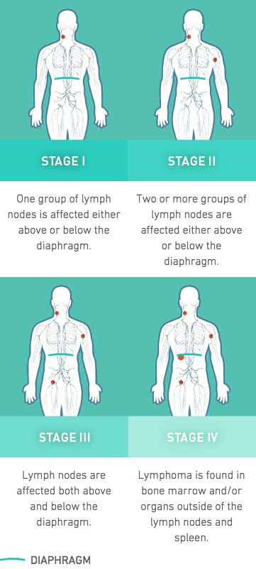 Non Hodgkins Lymphoma Nhl Stages Chart Non Hodgkins Lymphoma