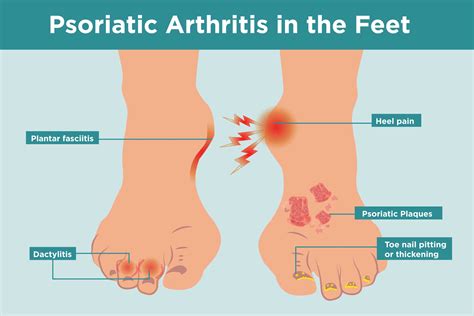 what psoriatic arthritis does to your feet and 6 ways to keep them healthy 2023