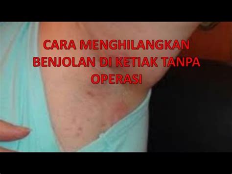 Cara mentghilangkan benjolan di ketiak , cara yang aman dan alami untuk menghilangkan benjolan di ketiak salah satu nya yaitu dengan obat tradisional ace max's , mengapa dikatakan demikian ? CARA MENGHILANGKAN BENJOLAN DI KETIAK TANPA OPERASI - YouTube