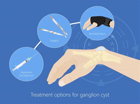 Ganglion Cyst Wrist Treatment Home