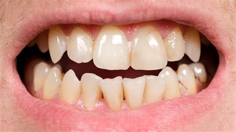 Difference Between Tartar And Teeth Stains Onlymyhealth