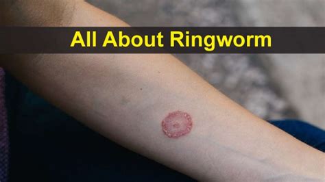 All About Ringworm Causes Symptoms Risk Factors Diagnosis