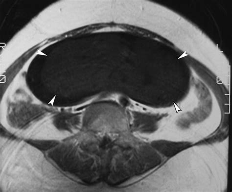 Atypical Ct And Mri Manifestations Of Mature Ovarian Cystic Teratomas Ajr