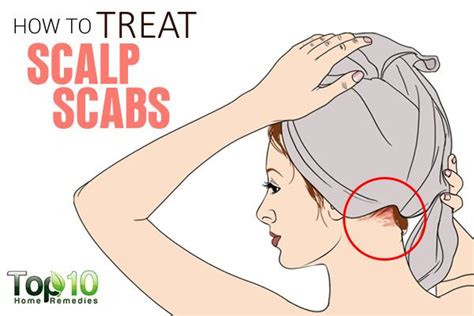 how to treat scalp scabs top 10 home remedies