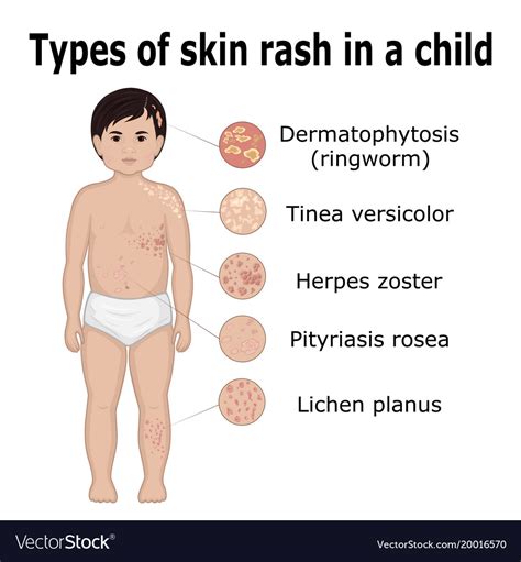 Rash Types With Pictures Types Of Rashes Common Skin Rashes Types Images
