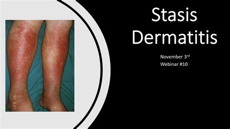 Webinar 10 Stasis Dermatitis Recharge Biomedical