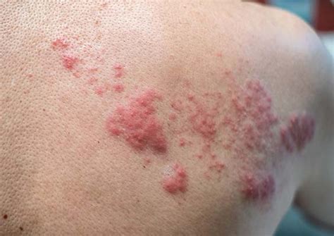 Infekcje Gronkowcowe Skóry Problem Wciąż Aktualny Wiadomości Dermatologiczne