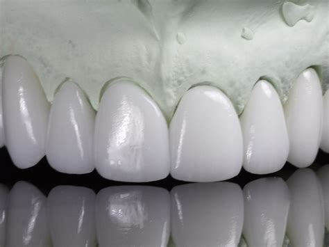 All Ceramic Restorations Triad Dental Studio