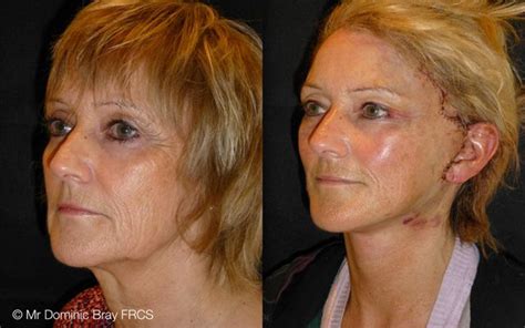 Lesley 62 Years Old Facelift Neck Lift Brow Lift