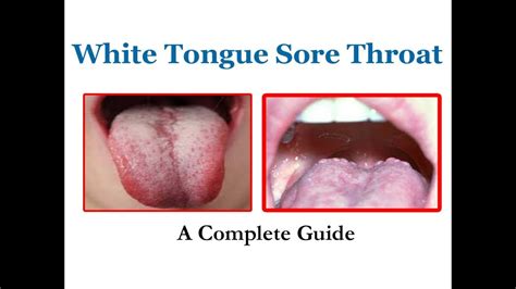 White Tongue Sore Throat A Complete Guide Youtube