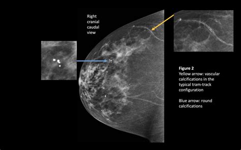 Figure Vascular And Round Calcifications Contributed By Brooke Bell