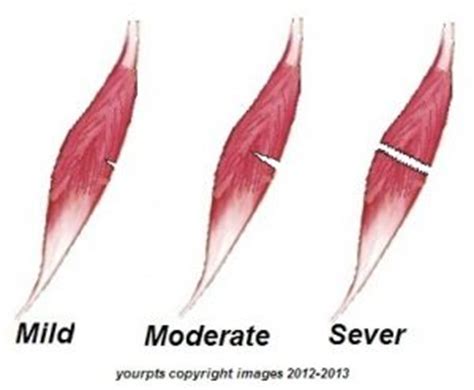 Acute Muscle Injuries What Are They And How To Manage Them