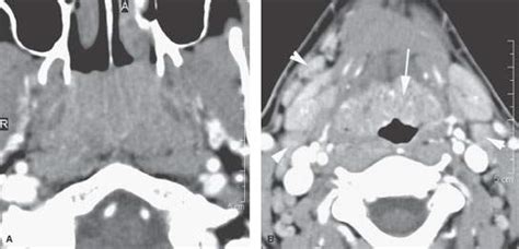 Nasopharynx Infections Radiology Key