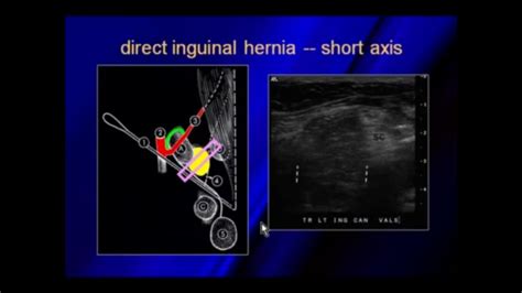 Ultrasound Of Hernias Movie Posters Poster Ultrasound Sexiz Pix