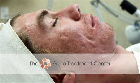 Conglobata Acne Treatment Photo Acne Treatment Center Portland Or