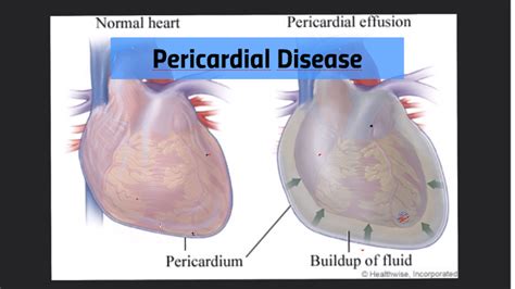 Pericardial Disease By Andrea Sadler