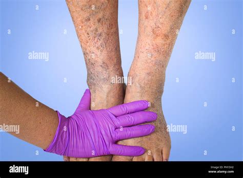Varicose Veins Men Hi Res Stock Photography And Images Alamy