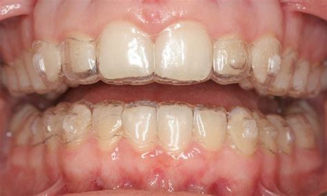 Maybe you would like to learn more about one of these? Invisalign Hampshire | Transparent Braces Portsmouth ...