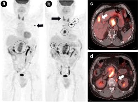 18f Fdg Petct Imaging Of The Pancreas Spectrum Of Diseases Nguyen