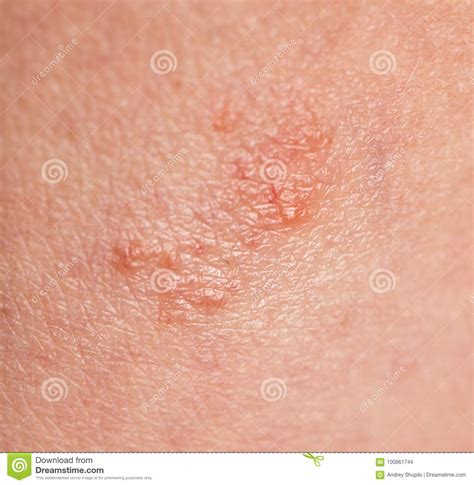 Fungus On Human Skin Macro Stock Photo Image Of Human Rotting