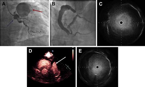 Asymptomatic Giant Coronary Artery Aneurysms Images From Coronary