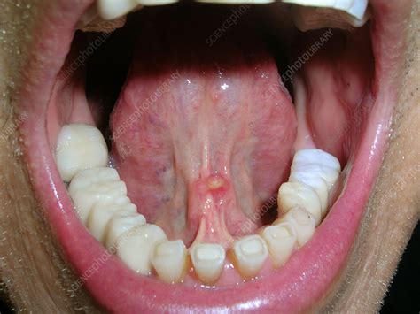 Mucocele Under Tongue Stock Image C0564885 Science Photo Library