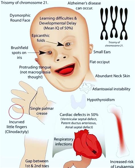 Downs Syndrome Clinical Features Dr Sk Sirs Biology
