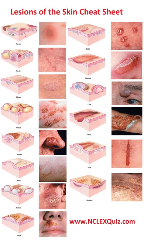 Some other symptoms of skin lesion include abnormal. Nursing Dermatology: Lesions of the Skin Cheat Sheet for ...