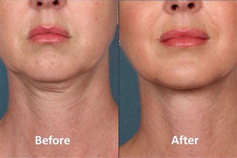 New Botox Kybella Banishes Double Chins So Hollywood Folk Can Eat