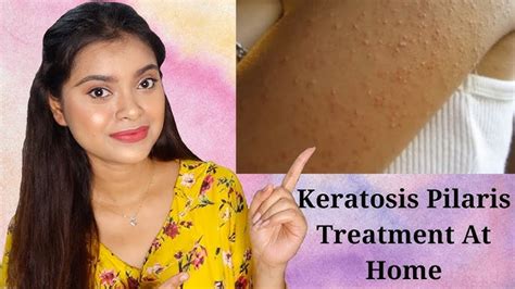 Coconut Oil For Keratosis Pilaris Before And After