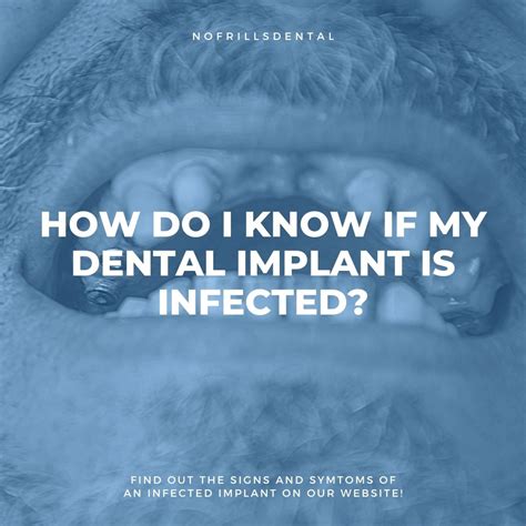 How Do I Know If My Dental Implant Is Infected Nofrills Dental