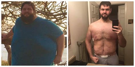 Man Loses 300 Lbs Has To Have Surgery To Remove 13 Lbs Of Extra Skin