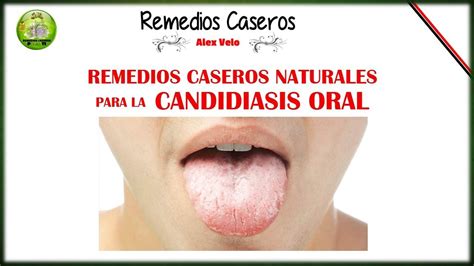 Remedios Caseros Naturales Para La Candidiasis Oral Youtube
