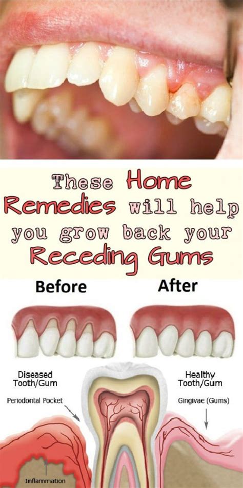 How To Fix Receding Gums Naturally Arviip